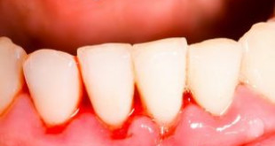 Nguyên nhân chảy máu chân răng và cách điều trị triệt để nhất
