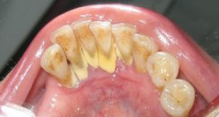 Cao răng quá nhiều – Thật nguy hiểm nếu không tìm cách giải quyết ngay