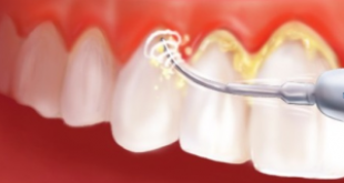 Cạo vôi răng có đau không – Tư vấn từ BS nha khoa?