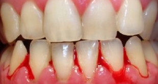 Có thể bạn sẽ bị sốc khi biết chảy máu răng là bệnh gì?