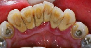 Lấy cao răng có đau không? – Lắng nghe tâm sự cùng chuyên gia
