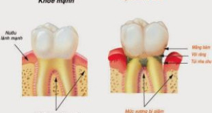 Cách lấy cao răng dưới nướu như thế nào và có thực sự tốt không?
