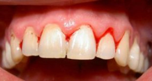 Tại sao bị chảy máu chân răng? Bắt bệnh chính xác và cách điều trị