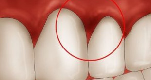 Những biểu hiện của bệnh viêm chân răng đừng nên coi thường