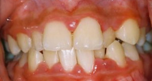 Viêm chân răng là một trong những bệnh lý răng miệng khiến bạn bị mất răng