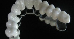 Bọc răng sứ Titan: Những điều bạn nên biết trước khi thực hiện