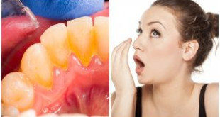 Cao răng có gây hôi miệng không? [Kiến thức nha khoa]