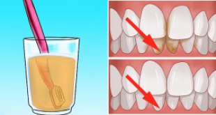 Lấy cao răng bằng phương pháp tự nhiên nhanh và hiệu quả cao