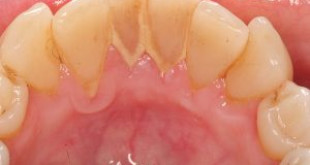 4 bệnh lý răng miệng từ cao răng mà ra, đừng bao giờ ngó lơ