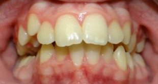 Chụp răng sứ làm thay đổi nụ cười của hàng triệu người như thế nào?