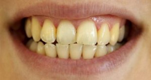 Những nguyên nhân làm cho răng bị vàng và cách khắc phục hiệu quả