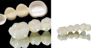 Răng sứ cercon zirconia – Tất cả những gì bạn cần phải biết