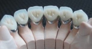 Bạn sẽ bất ngờ khi biết quy trình bọc răng sứ như thế nào chuẩn quốc tế?