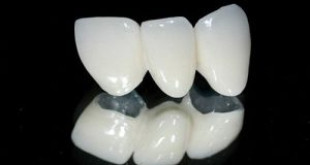 Răng sứ kim loại có tốt không? >>> Nghiên cứu của chuyên gia đầu ngành