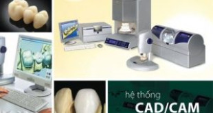 Bạn đã hiểu hết về răng Cercon chưa?