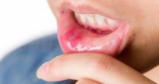 Những cách chữa nhiệt miệng TRIỆT ĐỂ bạn không thể không biết