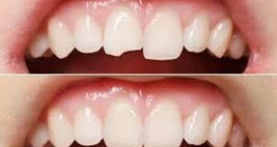 Phương pháp phục hình răng khi bị chết tủy