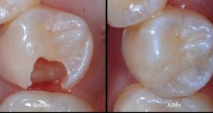 Cách trám răng có phải tối ưu khi sâu răng?
