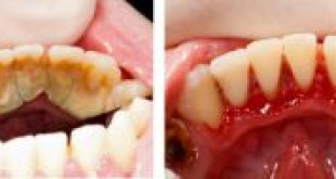 Điều trị viêm nướu bằng cách lấy cao răng