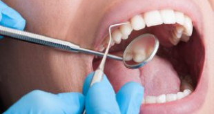 Lấy cao răng định kỳ có tốt không? – Ý kiến của chuyên gia