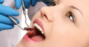 Lấy cao răng hết bao lâu thì xong? Thời gian thực hiện tại nha khoa