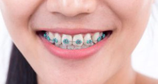 Lấy Cao Răng Khi Niềng Răng Được Không? 3 Cách thực hiện