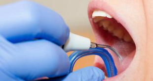 Lấy cao răng về bị chảy máu – Những mối lo cần phải dè chừng