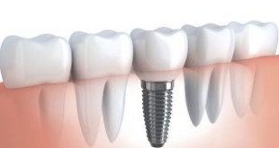 Địa chỉ trồng răng implant ở đâu tốt và uy tín tại Hà Nội