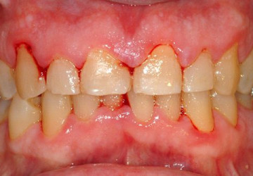 Cảnh báo các nguy hiểm tiềm tàng khi chảy máu răng nhiều