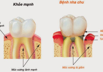 Cách lấy cao răng dưới nướu như thế nào và có thực sự tốt không?