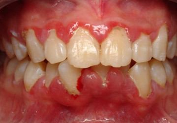 Viêm nướu răng – Cẩn thận nếu không muốn mất răng vĩnh viễn