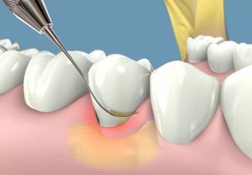 Nha sĩ lấy cao răng như thế nào? – Tìm hiểu quy trình làm dịch vụ