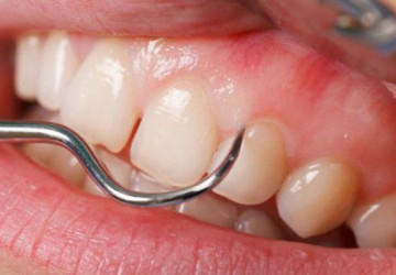 Lấy cao răng nha khoa có quy trình thực hiện như thế nào?