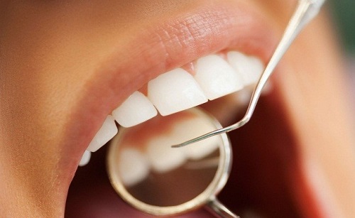 chăm sóc răng sau khi lấy cao răng 