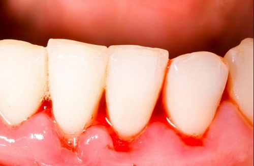 tác hại của vôi răng 