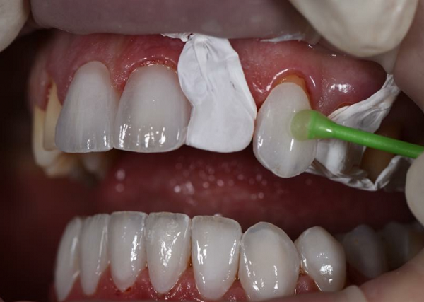 quy trình bọc răng sứ 5
