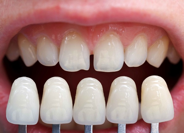 quy trình bọc răng sứ 