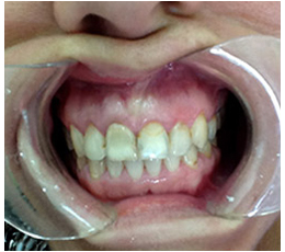 phục hình răng sứ 4