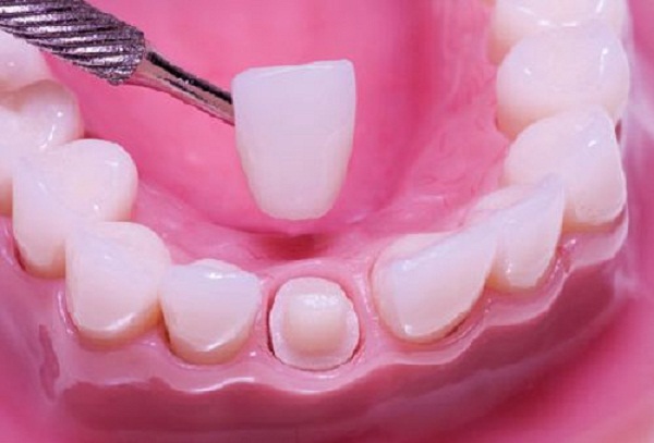 Bọc răng sứ mất bao lâu