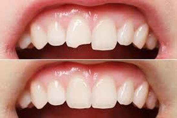 Bọc răng sứ phục hình răng khi bị chết tủy