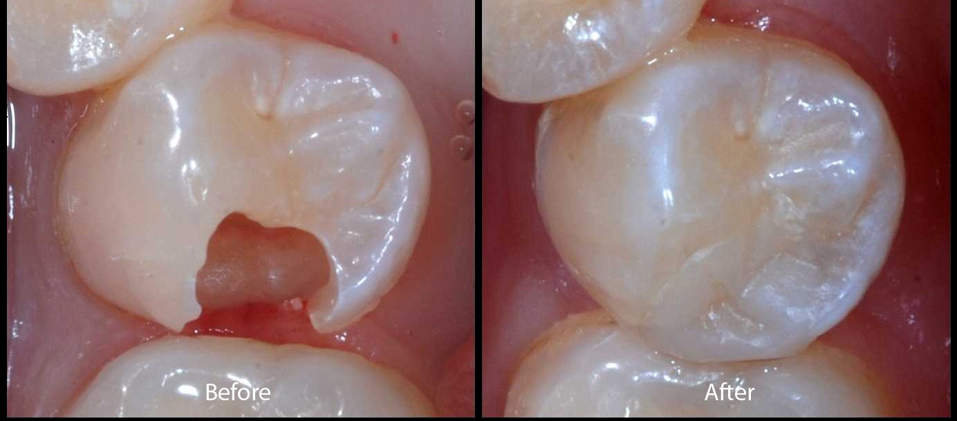 Cách trám răng có phải tối ưu khi sâu răng