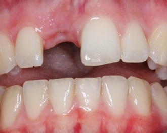 Mất răng làm tăng khả năng gây ung thư
