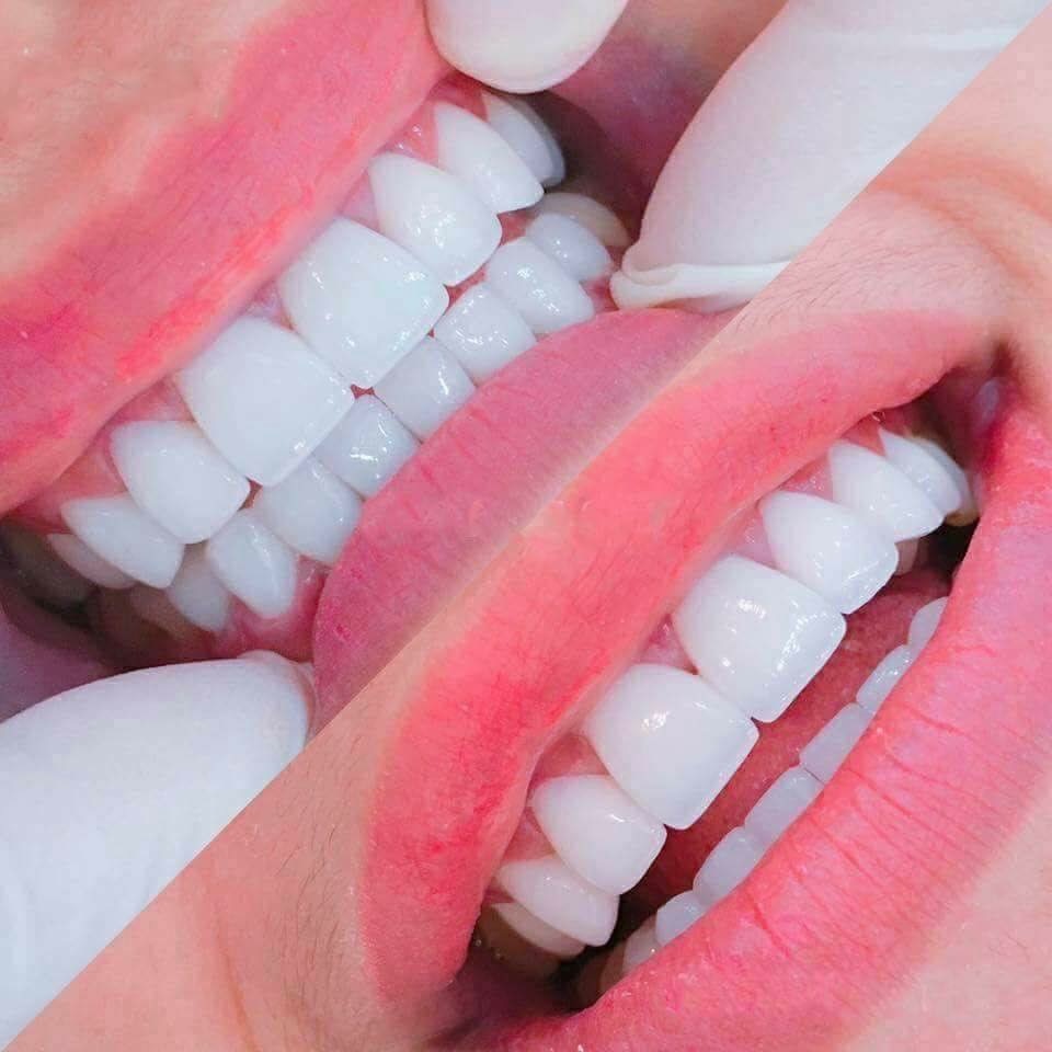 Bọc răng sứ để làm trắng răng