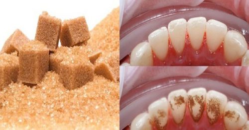 đường nâu giúp lấy cao răng bằng phương pháp tự nhiên