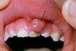 Bé bị sưng nướu răng – Bố mẹ chớ chủ quan với tình trạng này