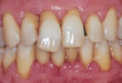 Bị viêm chân răng: Sức khỏe răng miệng nguy hại cũng chỉ vì thiếu hiểu biết