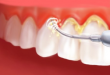 Cạo vôi răng có đau không – Tư vấn từ BS nha khoa?