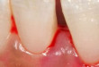 Nếu nghi ngờ chảy máu nướu răng là bệnh thì bạn nên xem ngay bài viết này