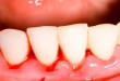 Hay chảy máu chân răng –  Một dấu hiệu tình trạng sức khỏe răng miệng đáng báo động
