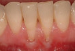 Tụt lợi chân răng – Không điều trị nhanh, bạn sẽ mất răng vĩnh viễn